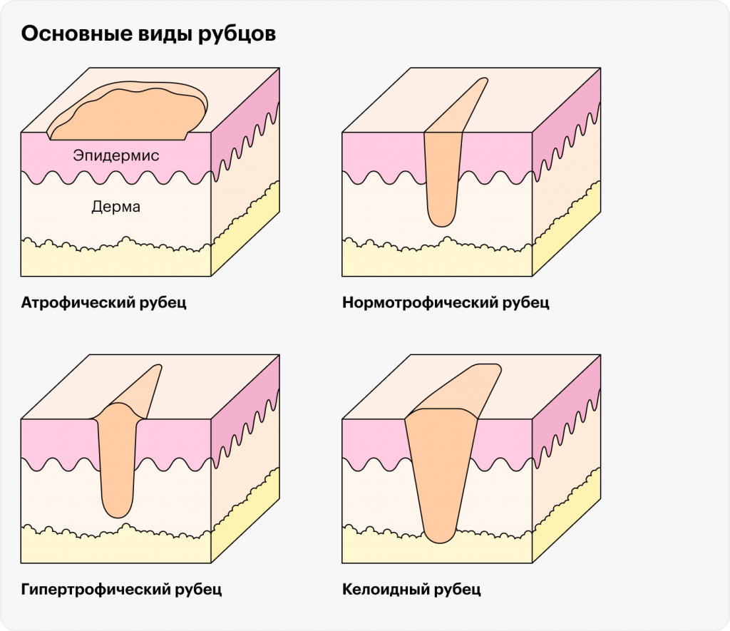 схема разных форм формирования рубцов